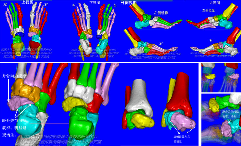 骨科診療邁入精準醫(yī)療時代，3D技術(shù)為骨科手術(shù)“保駕護航”