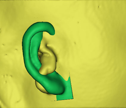 小耳畸形怎么辦？這有一份三維數(shù)字化治療方案請(qǐng)簽收！